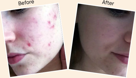 Result after Acne Treatment at skin health 
