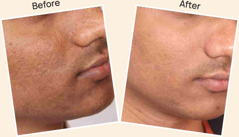 Result after Acne Scar Treatment at skin health 