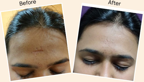 Result after Laser Scar Reduction at skin health 