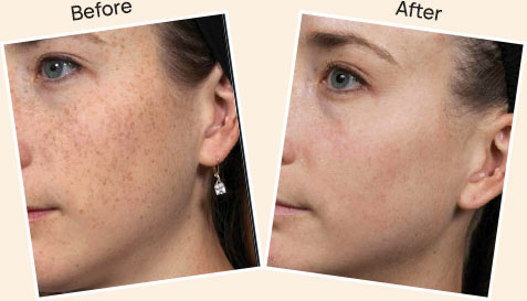 Result after Pigmentation Laser Treatment at skin health