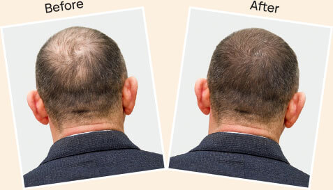 Result after PRP Hair Treatment at skin health 