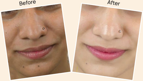 Result after Skin Brightening treatment at skin health 