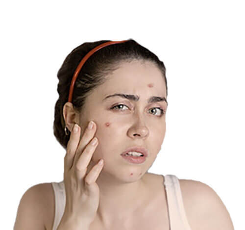 Acne Treatment in Chandigarh
