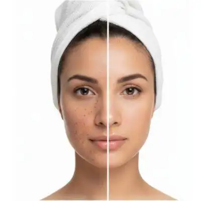 Pigmentation Treatment In Chandigarh